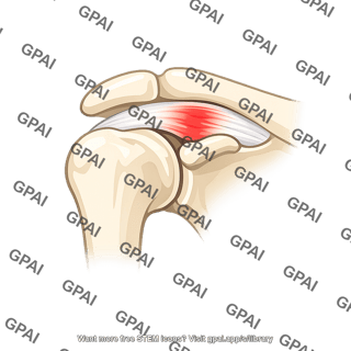 Subacromial impingement