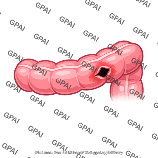Perforated bowel