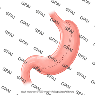 Sleeve gastrectomy remaining stomach