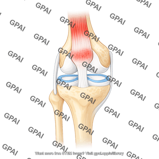 Knee joint anterior tendons inflamed quadriceps tendon
