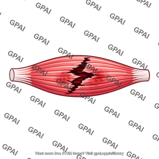 Muscle tear