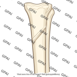 Soleal line