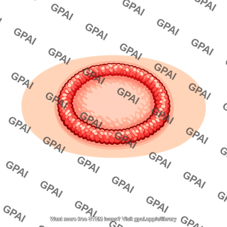 Ringworm lesion