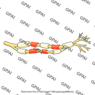 Demyelinated peripheral nerve