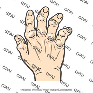 Hand deformed