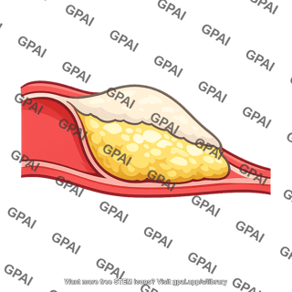 Atherosclerotic plaque