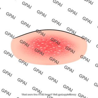 Irritated skin patch