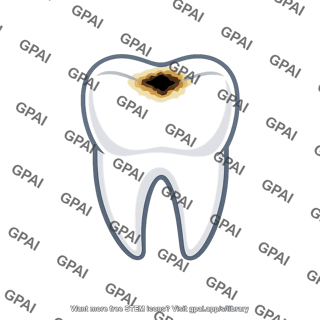 Tooth decay