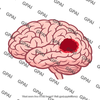 Brain stroke