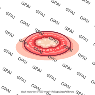 Skin ulcer