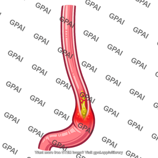 Esophagus reflux
