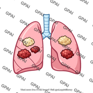 Lung cancer