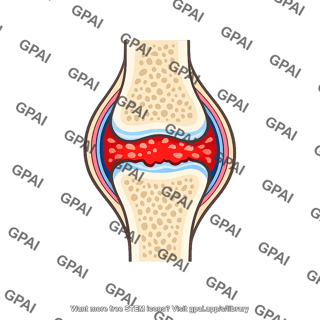 Arthritis joint