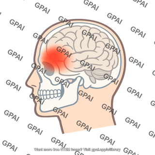 Migraine headache