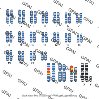 Human karyotype chronic myelogenous leukemia