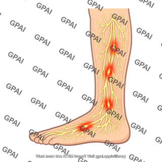 Neuropathy