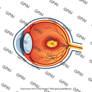Age related macular degeneration