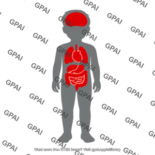 Multisystem inflammatory syndrome in children