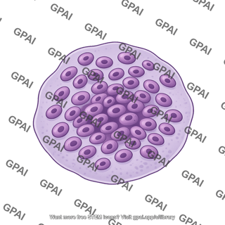 Foreign body giant cell