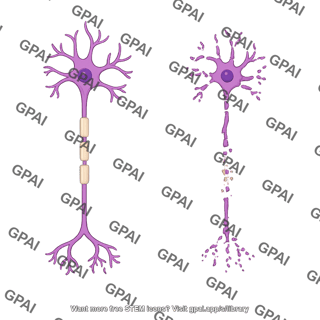 Multipolar neuron motor axon and dendritic degeneration