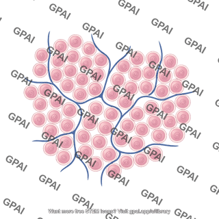 Anterior pituitary acinar structure adenoma