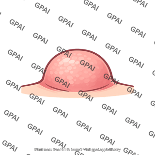 Fibroma