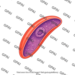 P. falciparum 5. female gametocyte