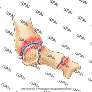 Mouse tibia talus tarsal joint arthritic