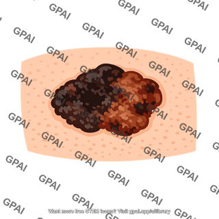 Skin cancer