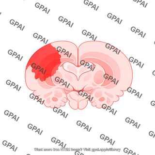 Mouse coronal brain with stroke