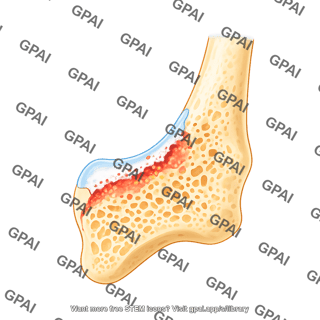 Mouse tibia distal end sagittal cut arthritic