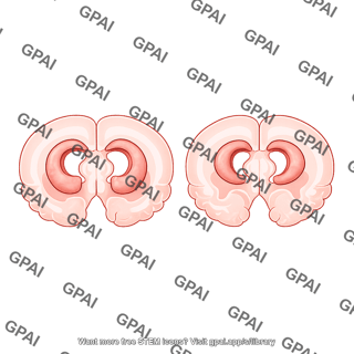 Mouse brain comparison coronal healthy vs. atrophied ventricles