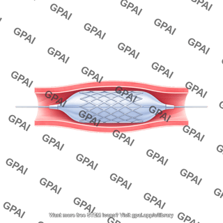 Angioplasty stent balloon inflated with stent in blood vessel cross section