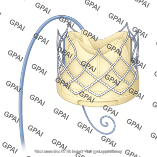 Transcatheter mitral valve