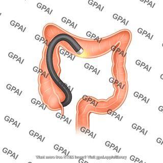 Endoscope colonoscopy
