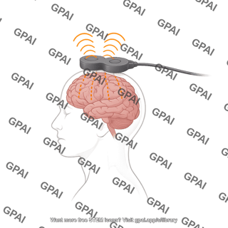 Transcranial magnetic stimulation coil on lateral male head