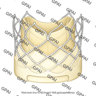 Transcatheter aortic valve replacement