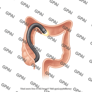Endoscope colonoscopy retroflexion