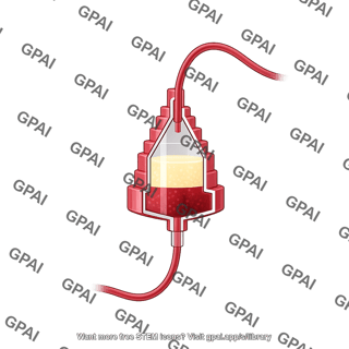 Leukocyte reduction system chamber cut full