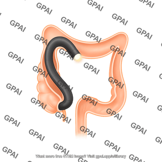 Endoscope sigmoidoscopy
