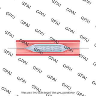 Angioplasty balloon deflated with stent in blood vessel cross section