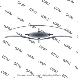 Contact stress patch