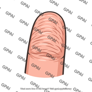Finger wrinkled