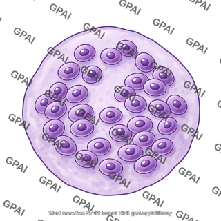 Foreign body giant cell 1