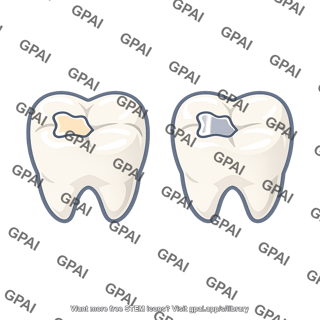 Dental filling