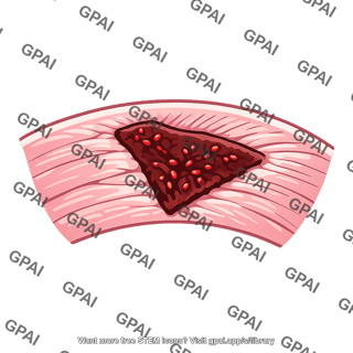 Myocardial infarction hemorrhagic variant
