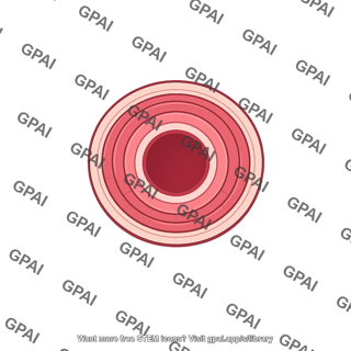 Blood vessel inward eutrophic remodeling