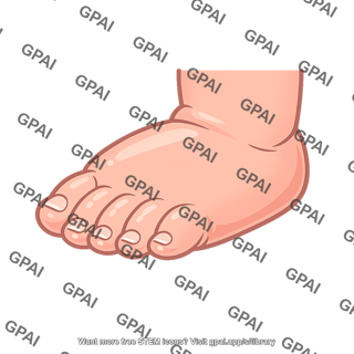 Infant extremity edema