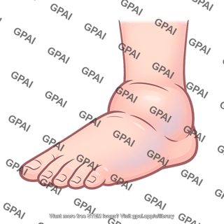 Edema