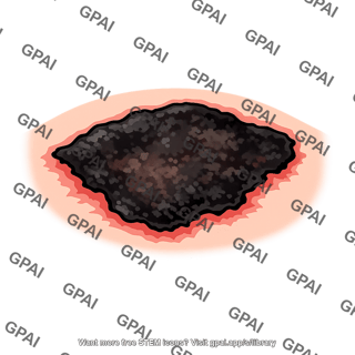 Skin gangrenous